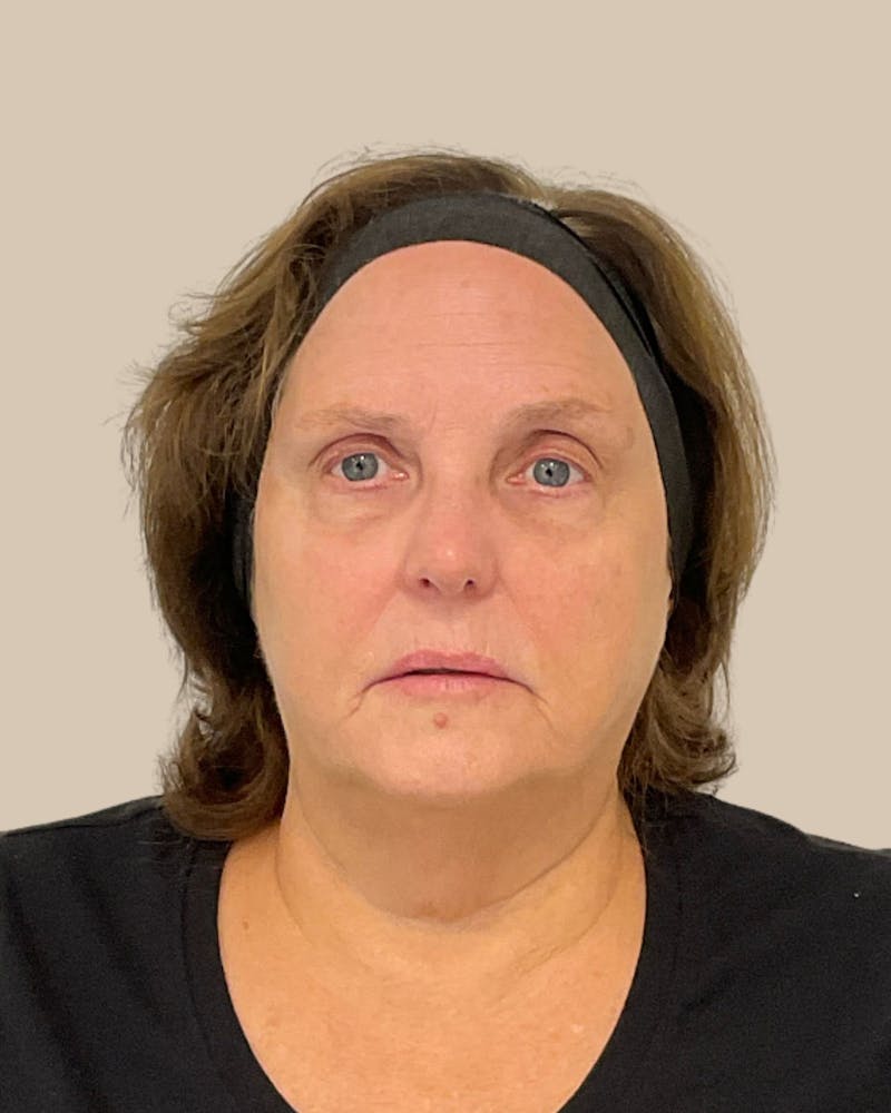 Microneedling Before & After Gallery - Patient 297620 - Image 2