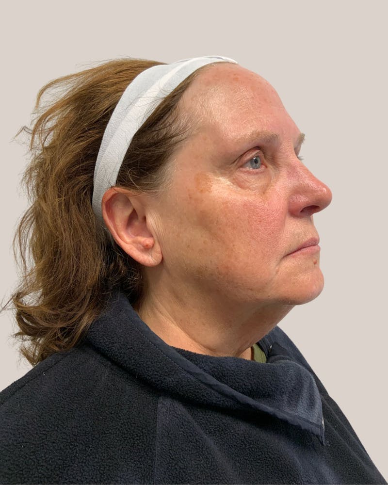 Microneedling Before & After Gallery - Patient 297620 - Image 3