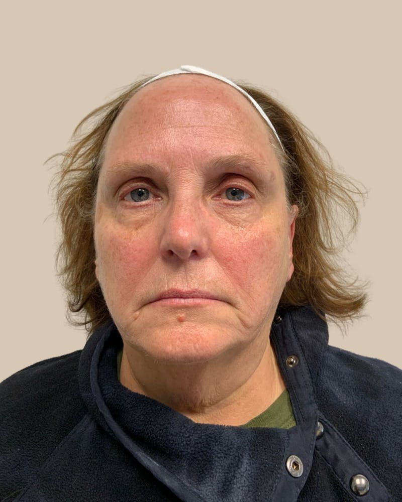 Microneedling Before & After Gallery - Patient 297620 - Image 1