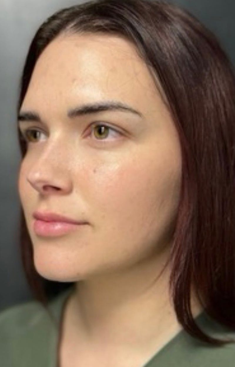 Injectables Before & After Gallery - Patient 238595 - Image 5