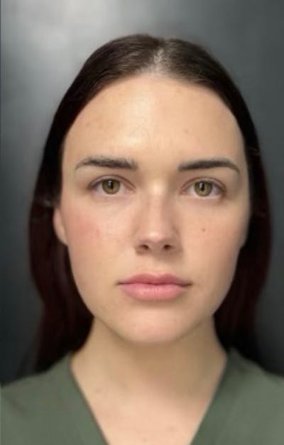 Injectables Before & After Gallery - Patient 238595 - Image 2