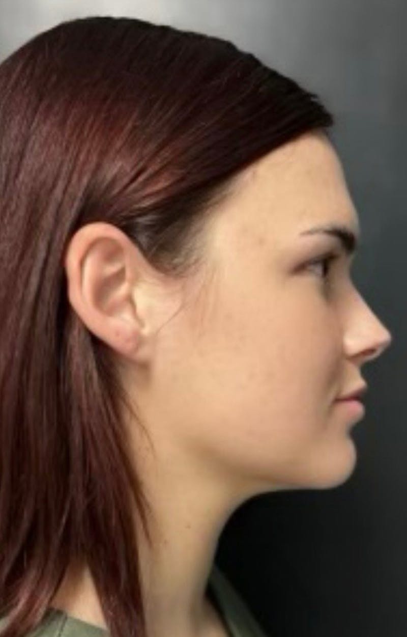 Injectables Before & After Gallery - Patient 238595 - Image 3