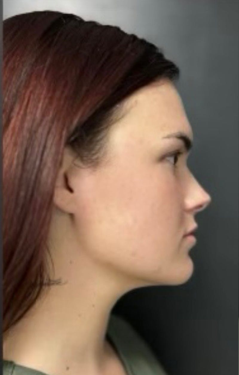 Injectables Before & After Gallery - Patient 238595 - Image 4