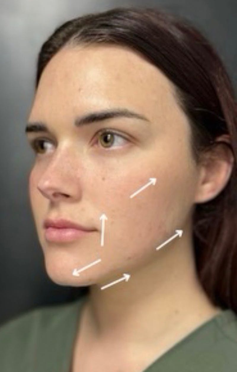Injectables Before & After Gallery - Patient 238595 - Image 6