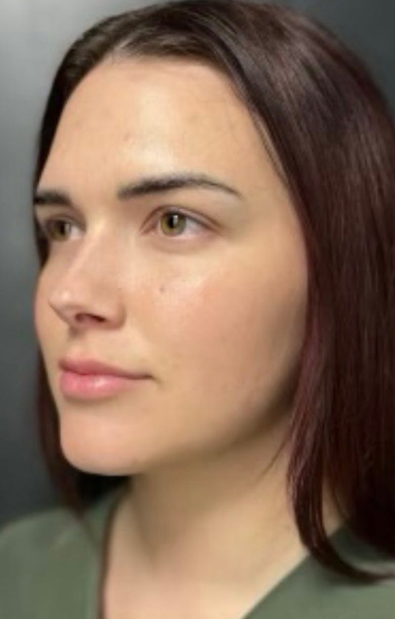 Injectables Before & After Gallery - Patient 238595 - Image 7