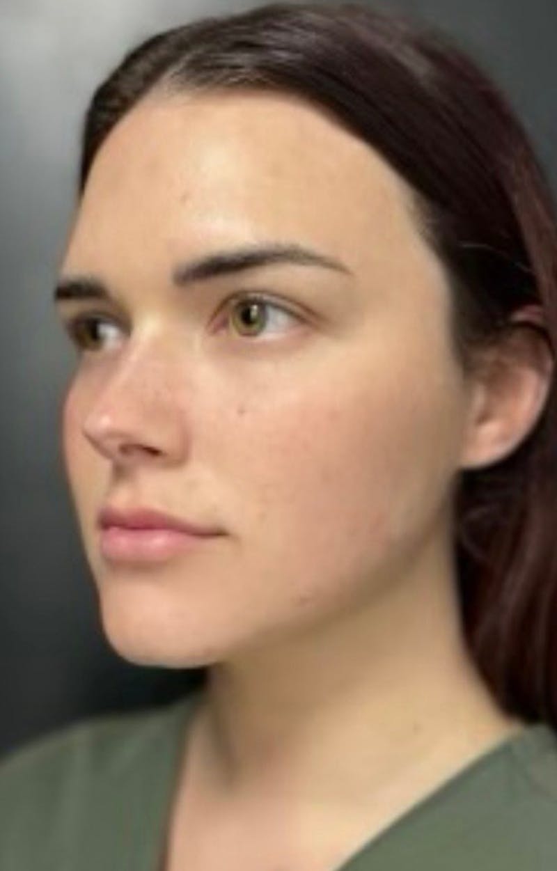Injectables Before & After Gallery - Patient 238595 - Image 8