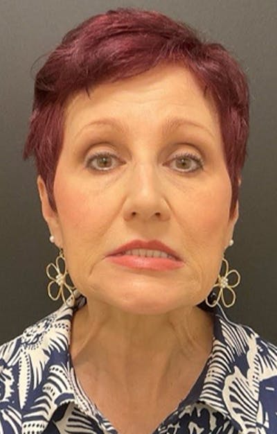 Injectables Before & After Gallery - Patient 287818 - Image 1