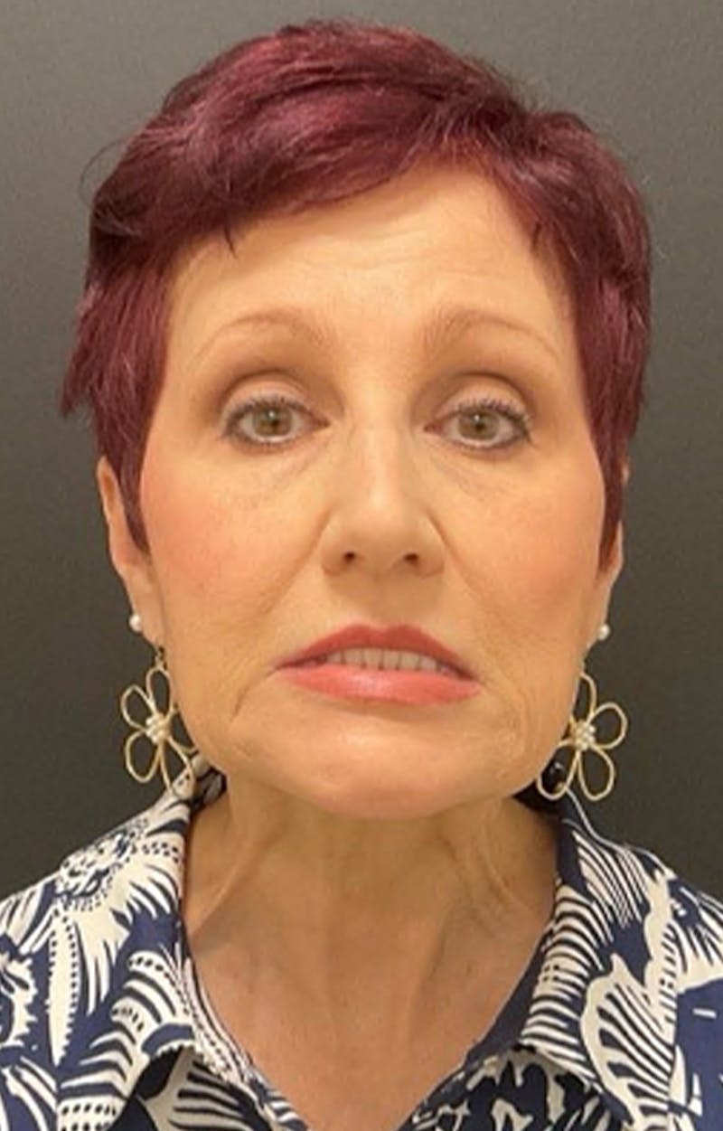 Injectables Before & After Gallery - Patient 287818 - Image 1