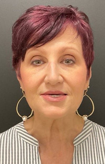 Injectables Before & After Gallery - Patient 287818 - Image 2