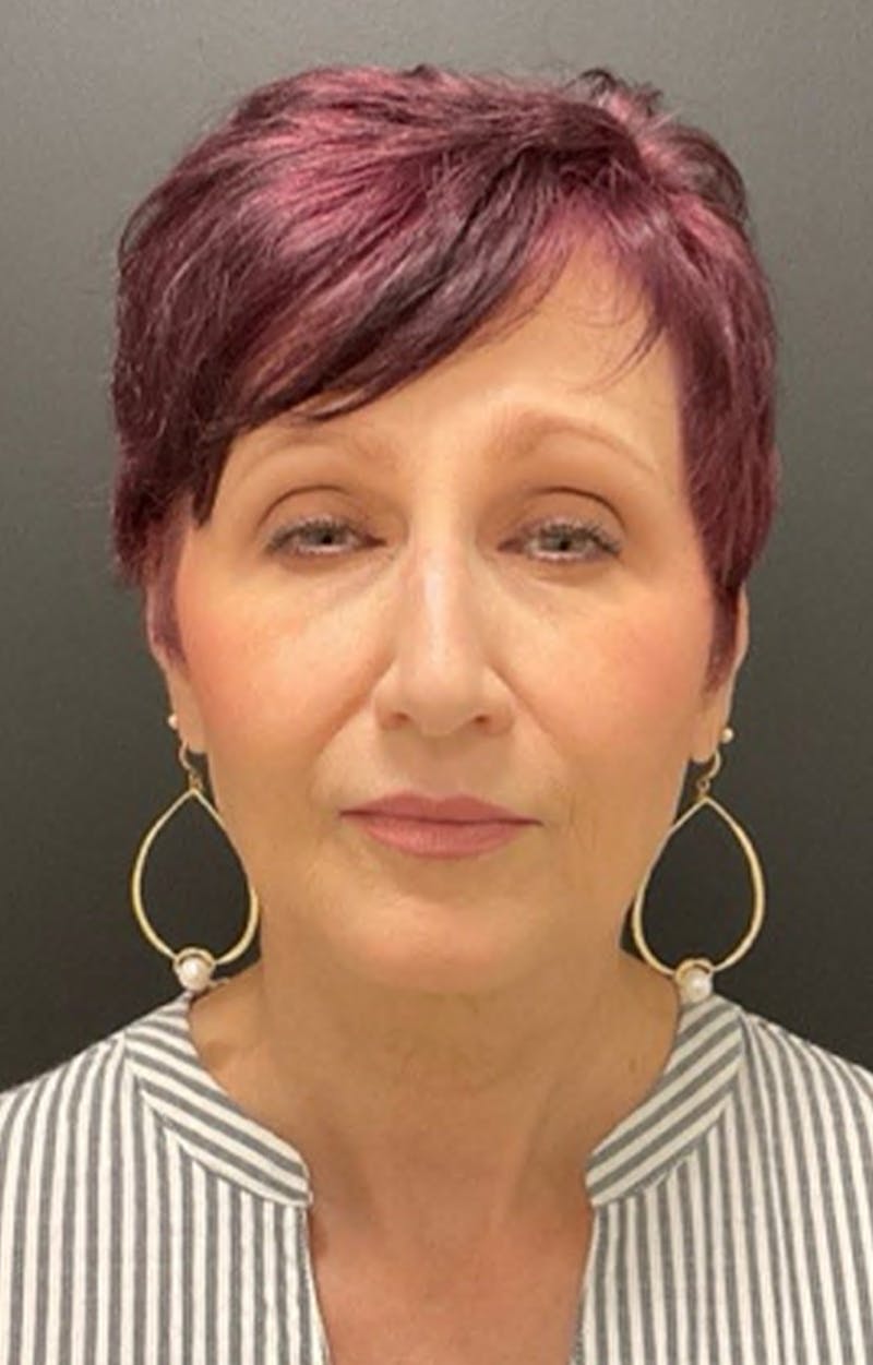 Injectables Before & After Gallery - Patient 287818 - Image 4