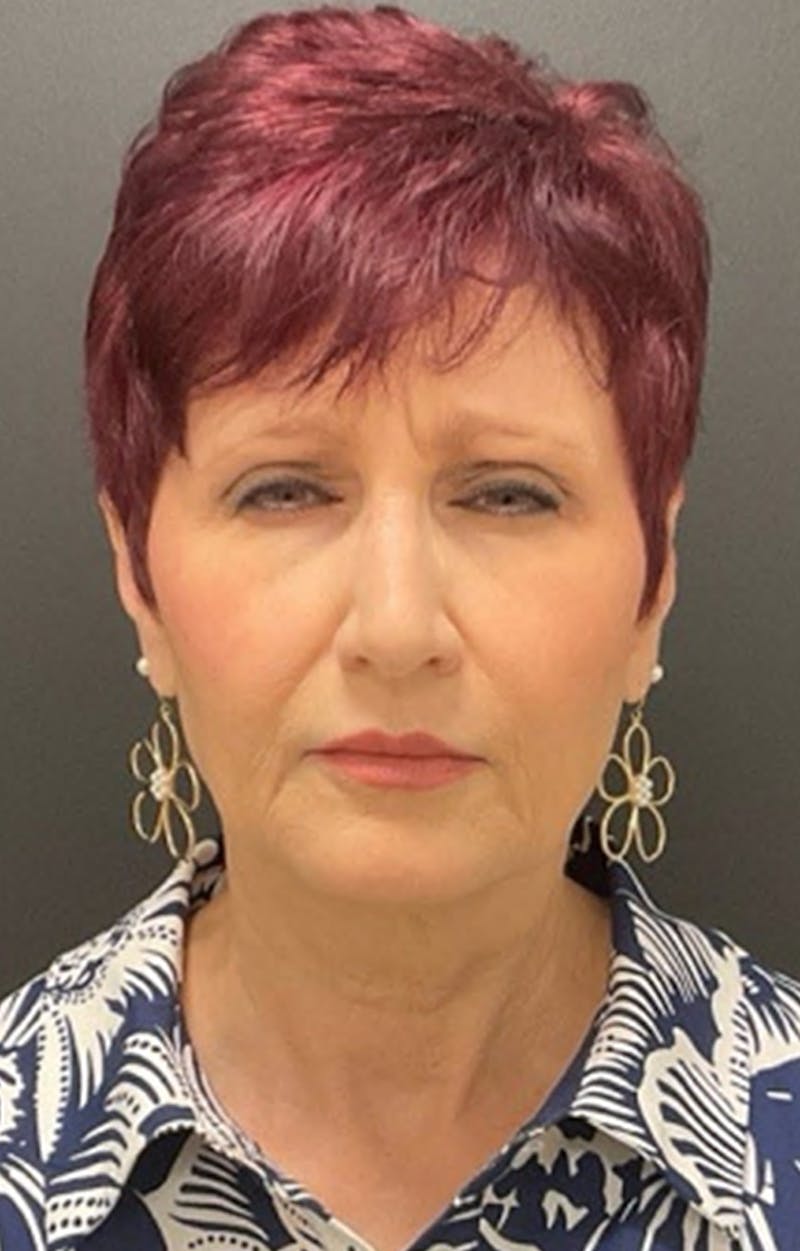 Injectables Before & After Gallery - Patient 287818 - Image 3