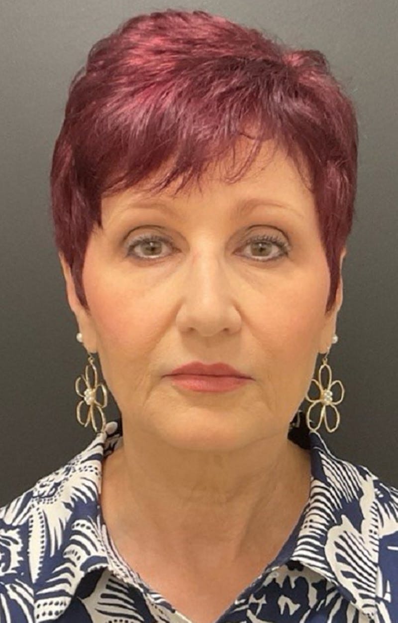 Injectables Before & After Gallery - Patient 287818 - Image 5