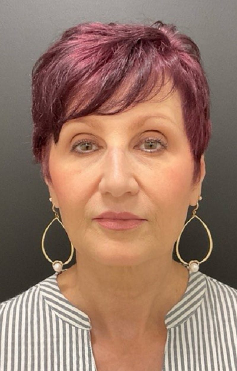 Injectables Before & After Gallery - Patient 287818 - Image 6