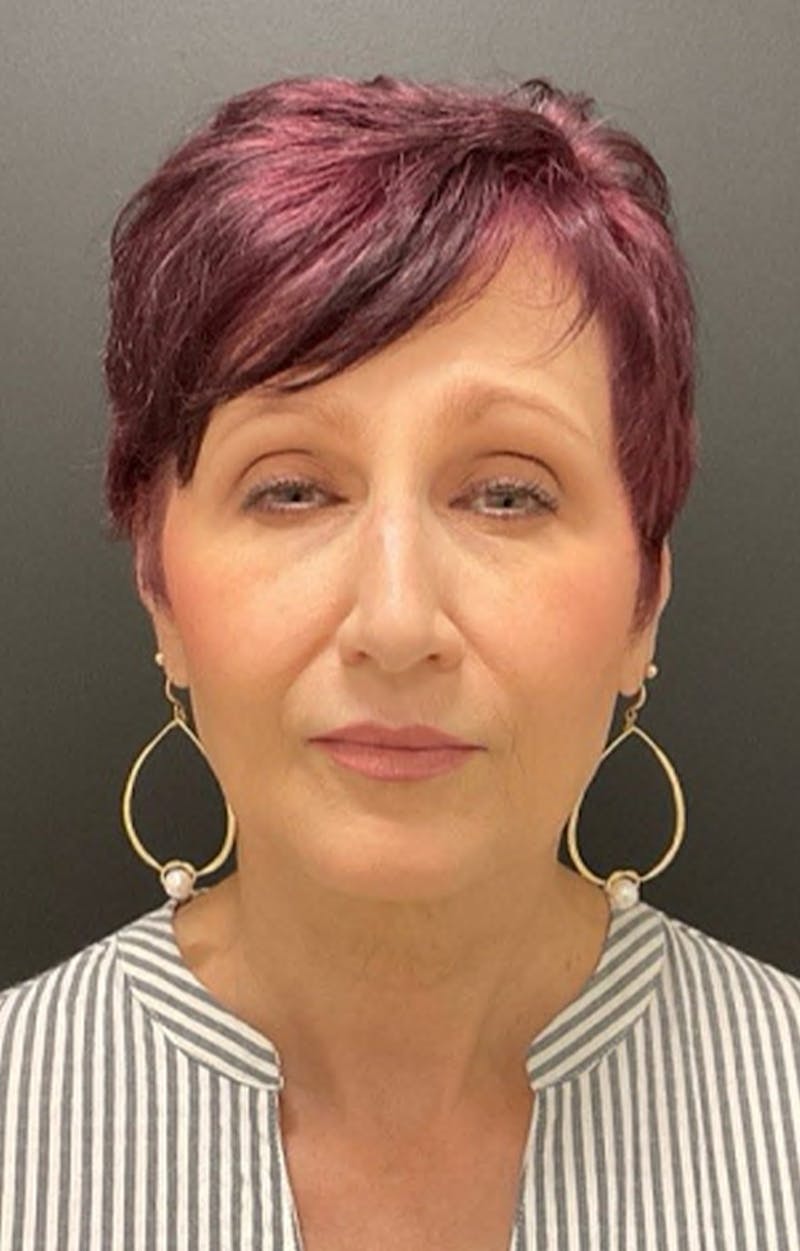 Injectables Before & After Gallery - Patient 287818 - Image 8