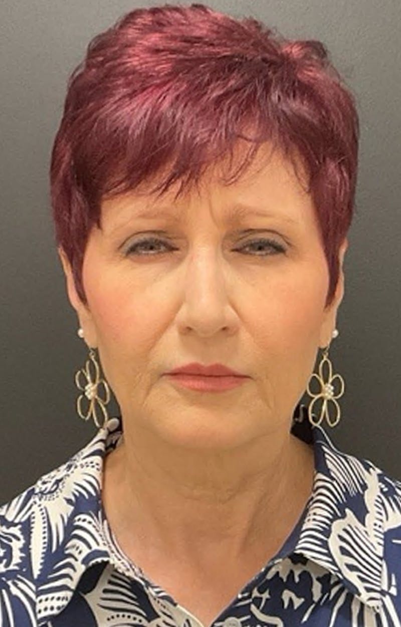 Injectables Before & After Gallery - Patient 287818 - Image 7