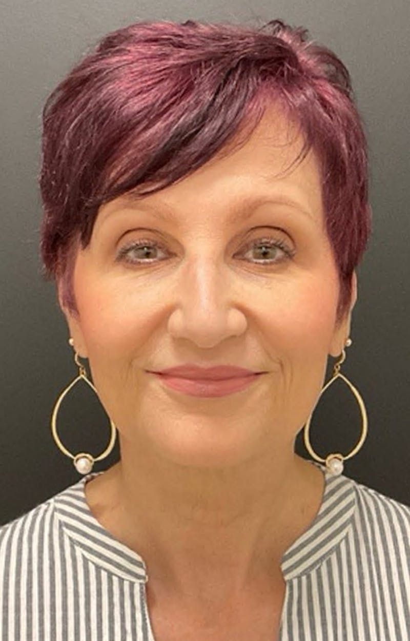 Injectables Before & After Gallery - Patient 287818 - Image 10