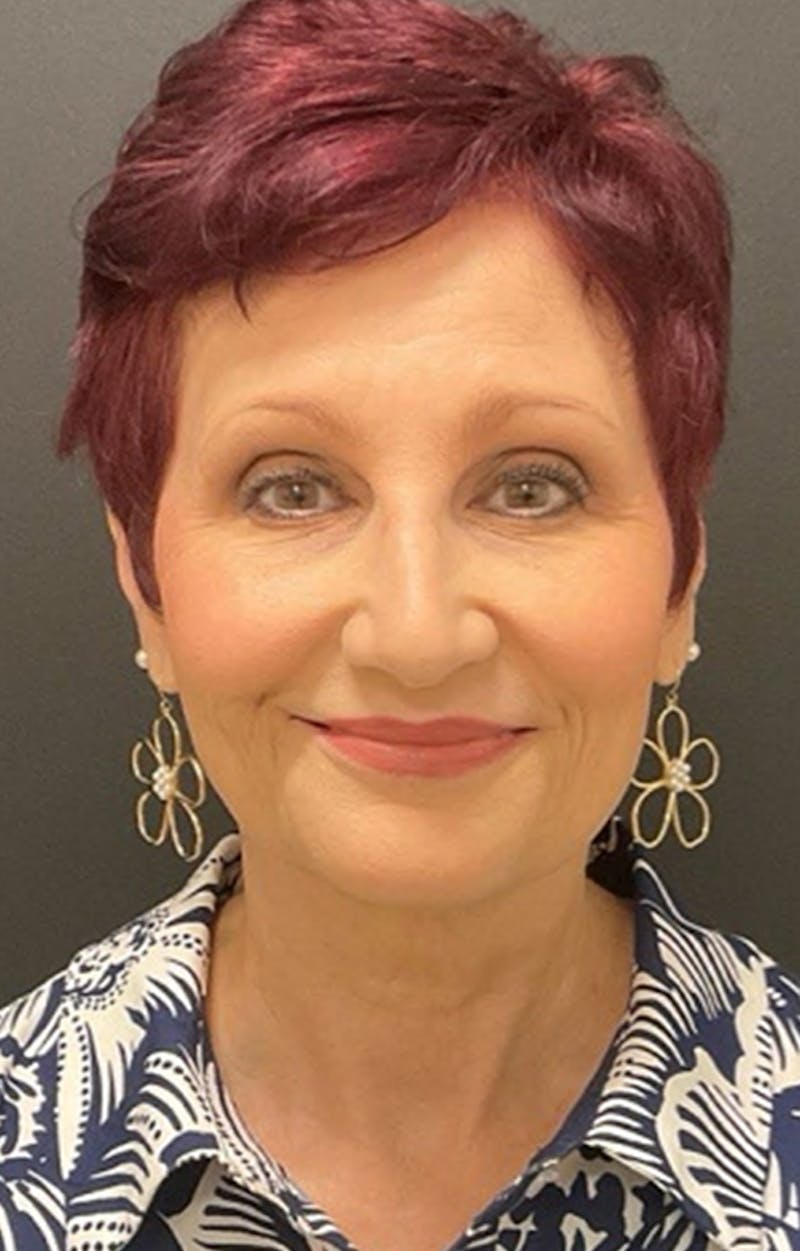 Injectables Before & After Gallery - Patient 287818 - Image 9