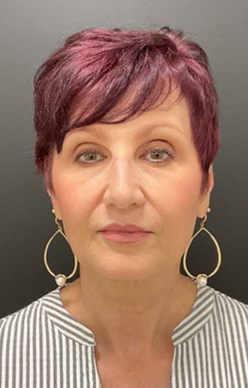 Injectables Before & After Gallery - Patient 287818 - Image 12