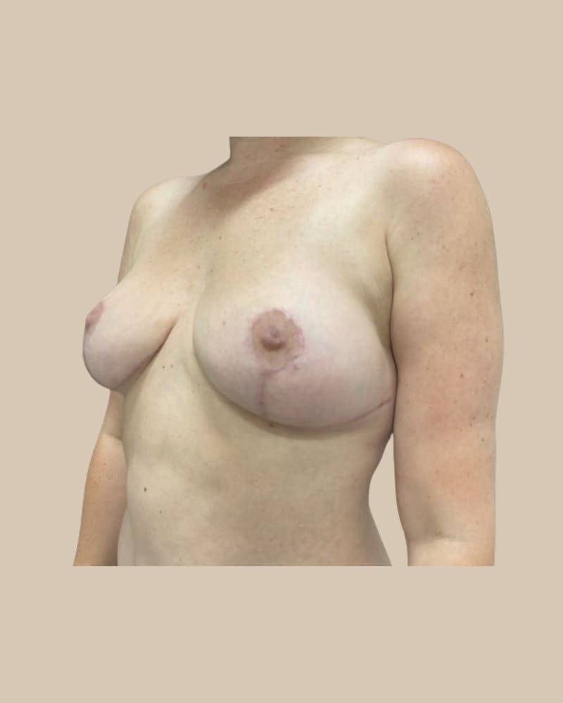 Breast Lift Before & After Gallery - Patient 295895 - Image 4