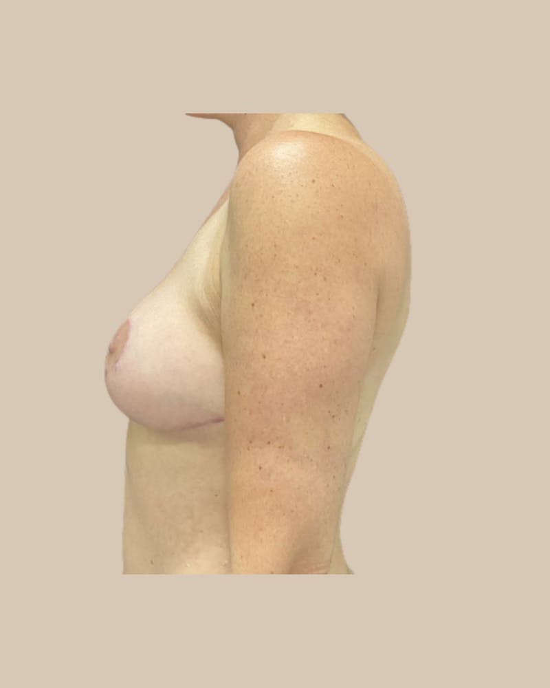 Breast Lift Before & After Gallery - Patient 295895 - Image 6