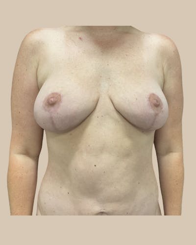 Breast Lift Before & After Gallery - Patient 295895 - Image 2