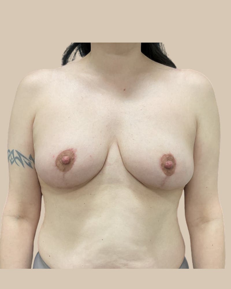 Breast Lift Before & After Gallery - Patient 226943 - Image 2