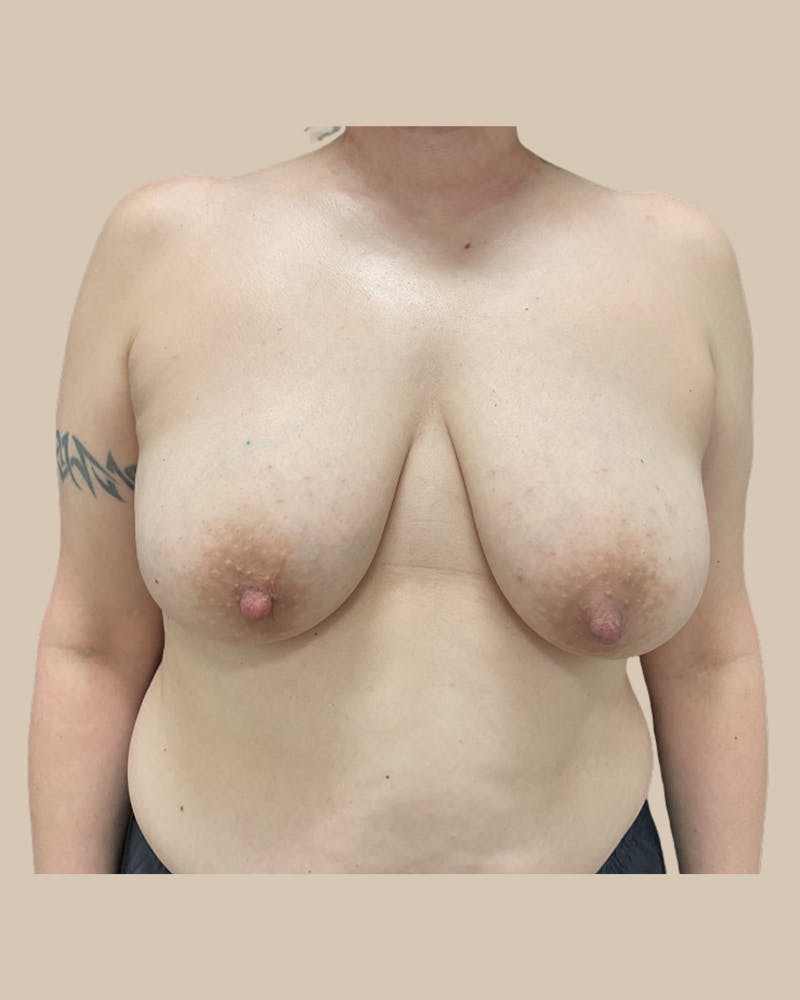 Breast Lift Before & After Gallery - Patient 226943 - Image 1