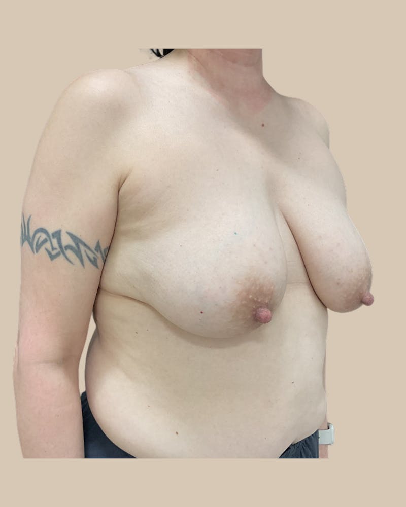 Breast Lift Before & After Gallery - Patient 226943 - Image 3