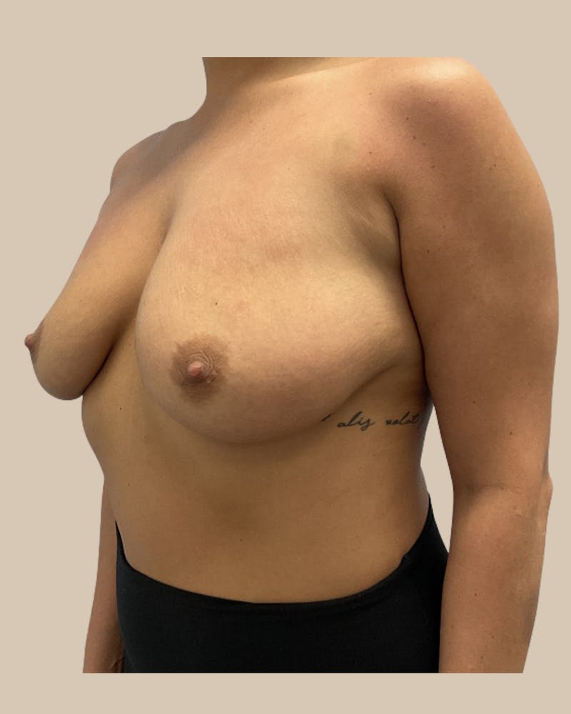 Breast Lift Before & After Gallery - Patient 241120 - Image 3