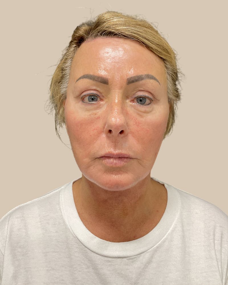 Forehead Reduction Before & After Gallery - Patient 253299 - Image 2