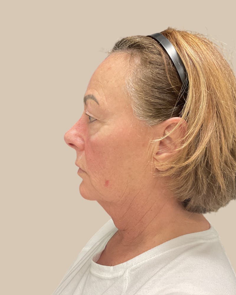 Forehead Reduction Before & After Gallery - Patient 253299 - Image 7