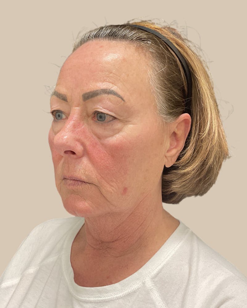 Forehead Reduction Before & After Gallery - Patient 253299 - Image 5