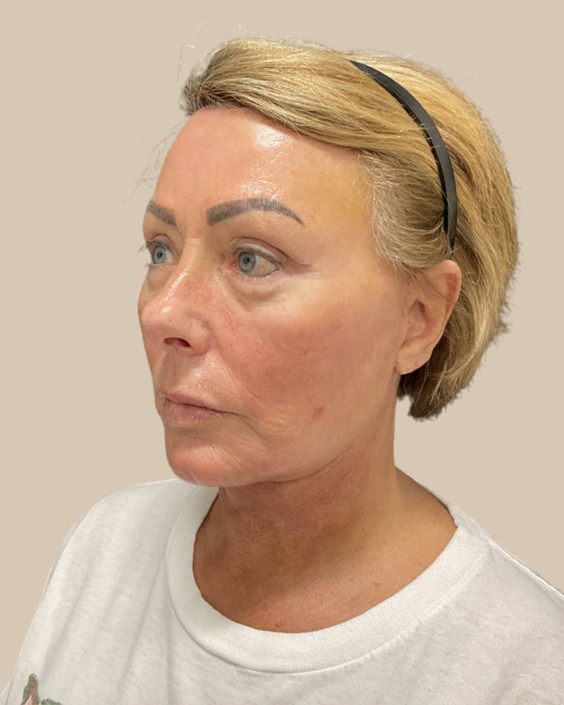 Forehead Reduction Before & After Gallery - Patient 253299 - Image 6