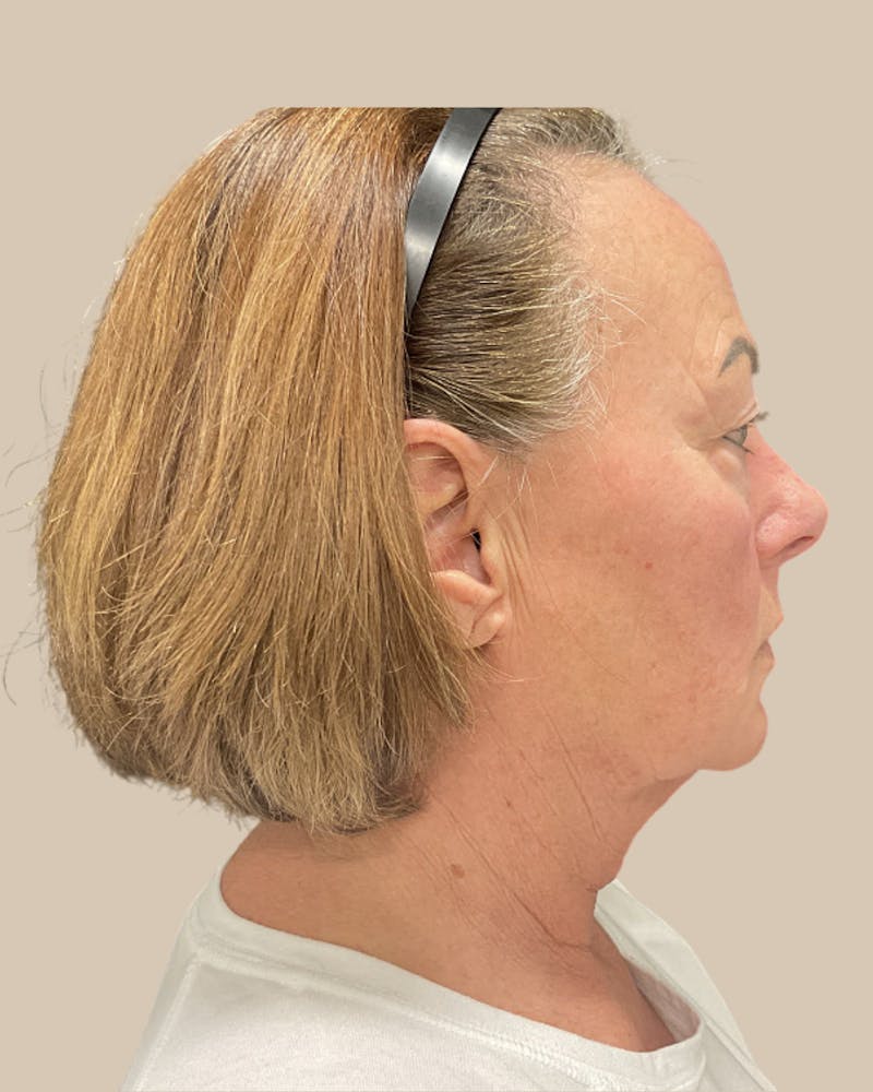 Forehead Reduction Before & After Gallery - Patient 253299 - Image 3