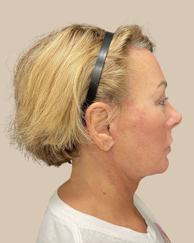 Forehead Reduction Before & After Gallery - Patient 253299 - Image 4