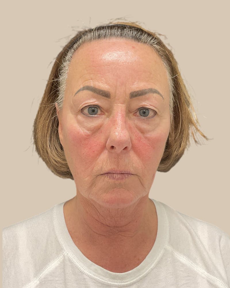 Forehead Reduction Before & After Gallery - Patient 253299 - Image 1