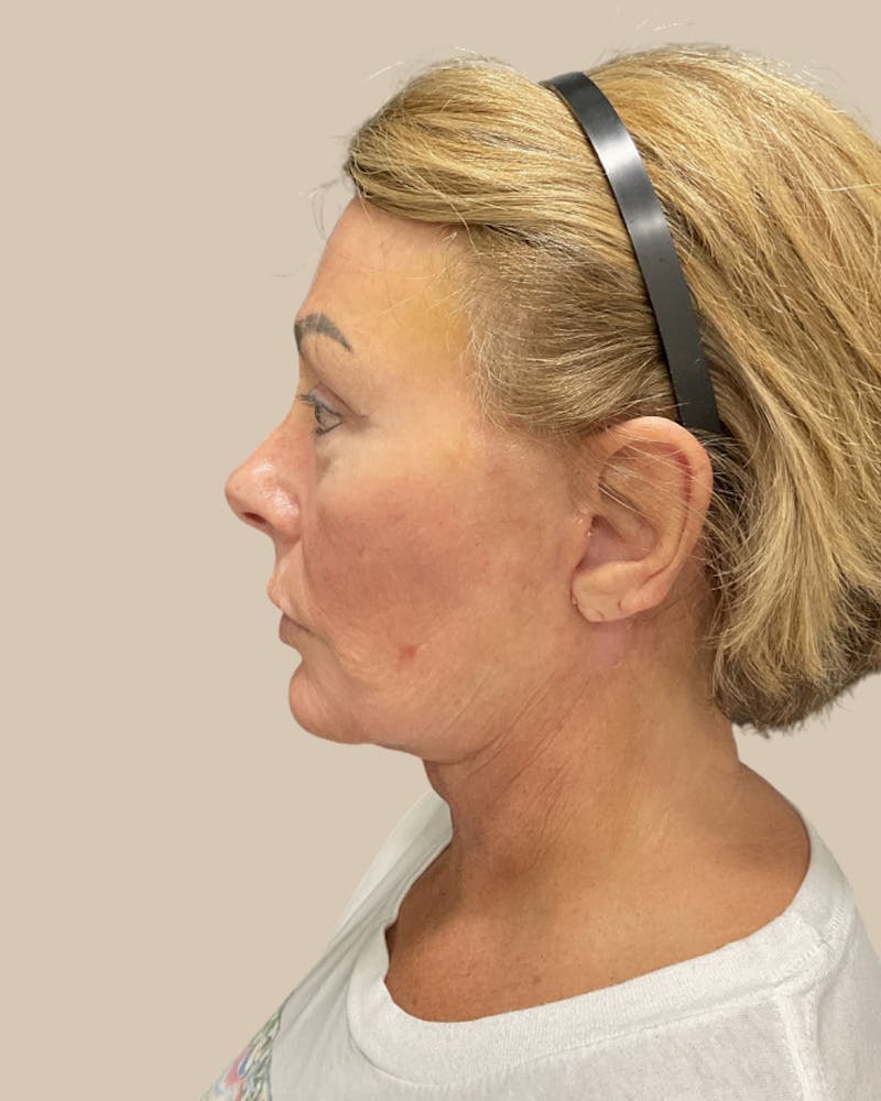 Forehead Reduction Before & After Gallery - Patient 253299 - Image 8