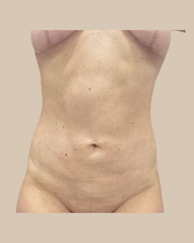 Liposuction Before & After Gallery - Patient 270976 - Image 2