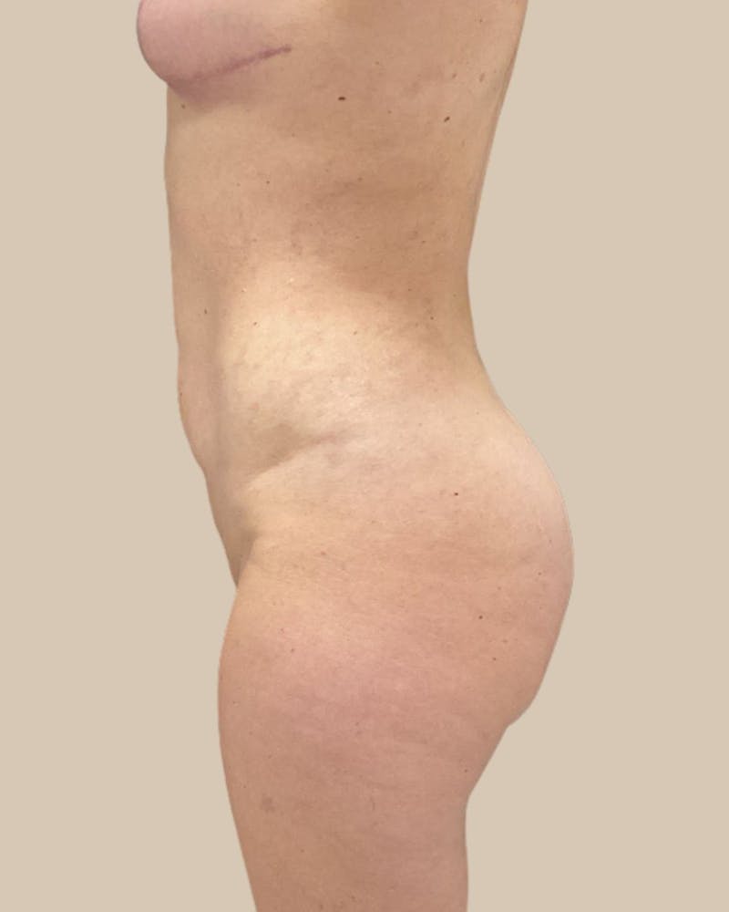 Liposuction Before & After Gallery - Patient 270976 - Image 4