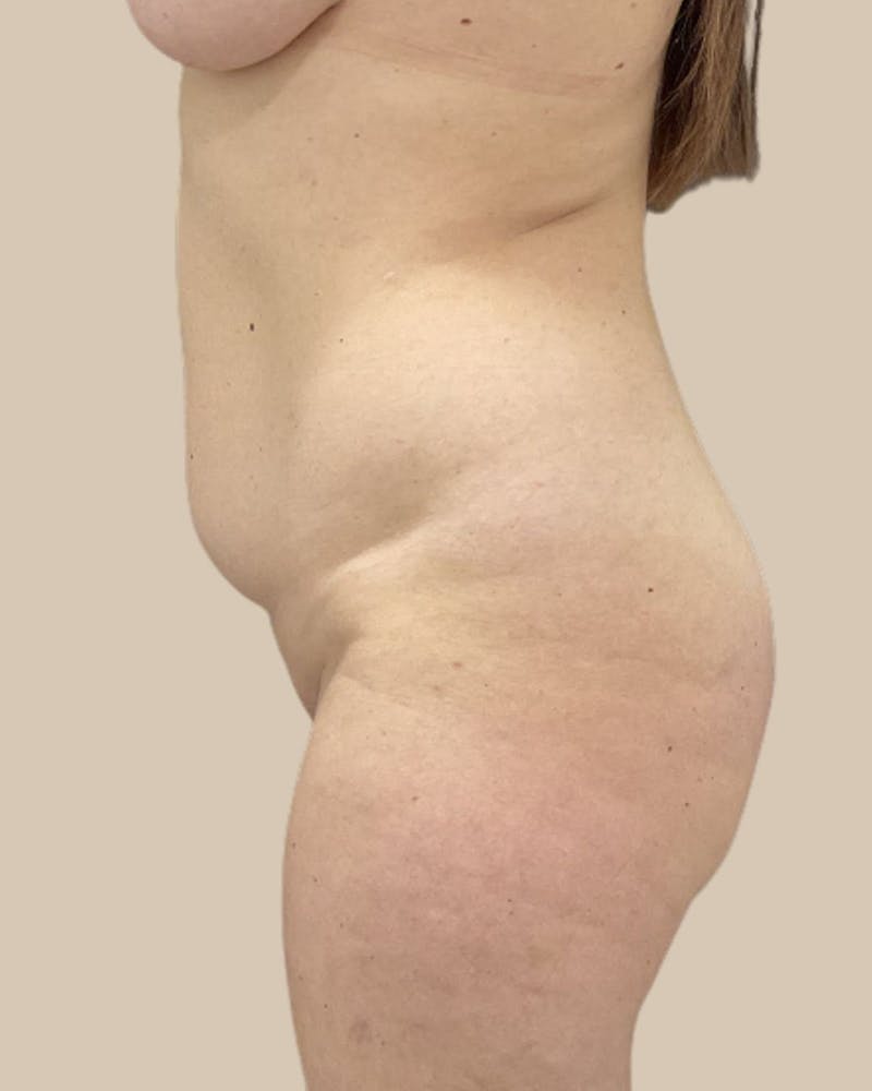 Liposuction Before & After Gallery - Patient 270976 - Image 3