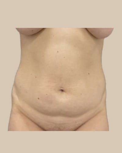 Liposuction Before & After Gallery - Patient 270976 - Image 1