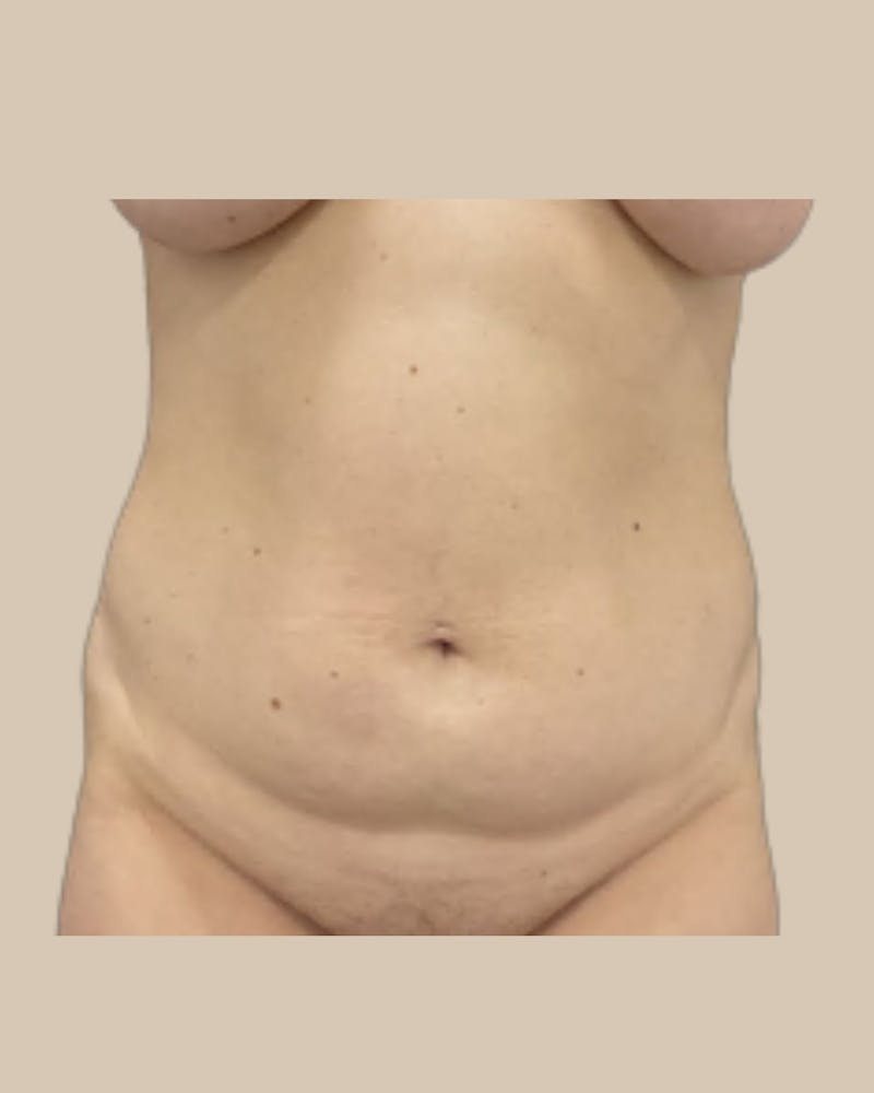 Liposuction Before & After Gallery - Patient 270976 - Image 1