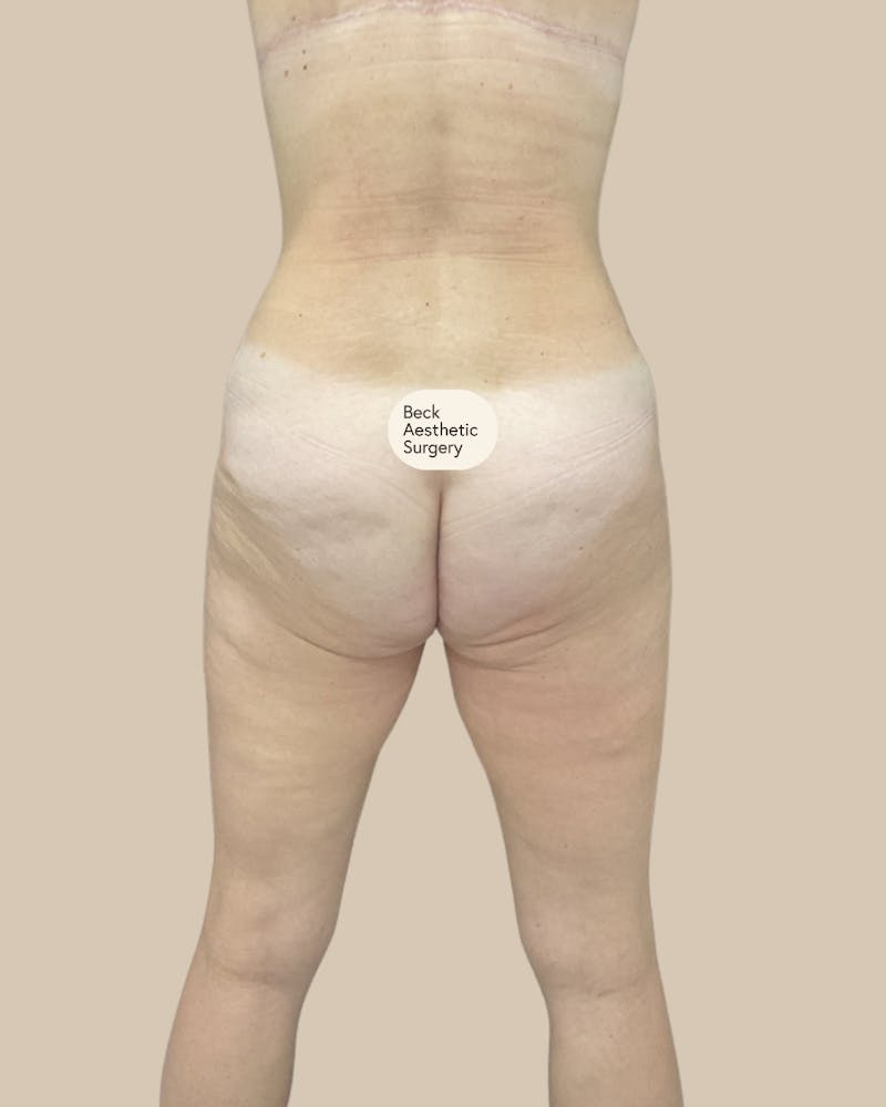 Tummy Tuck Before & After Gallery - Patient 261015 - Image 6