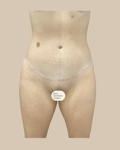 Tummy Tuck Before & After Gallery - Patient 261015 - Image 2