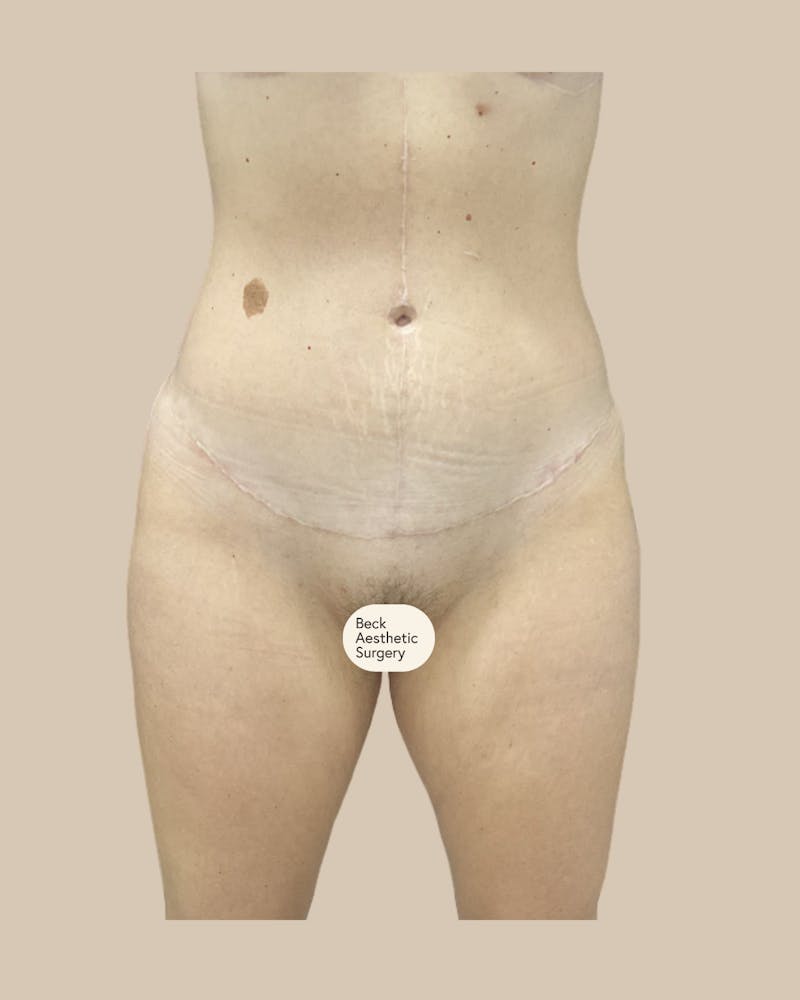 Tummy Tuck Before & After Gallery - Patient 261015 - Image 2