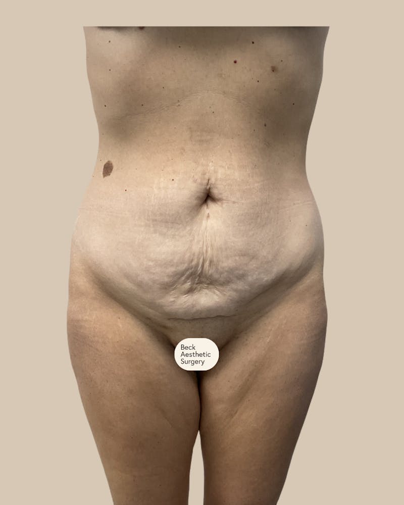 Tummy Tuck Before & After Gallery - Patient 261015 - Image 1