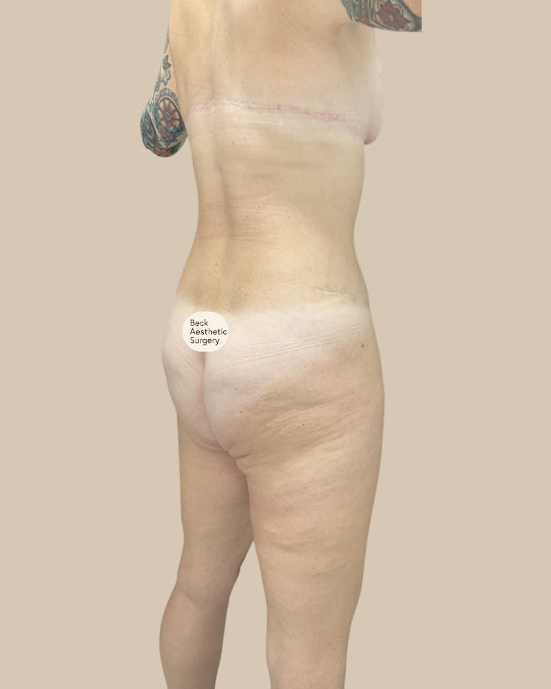 Tummy Tuck Before & After Gallery - Patient 261015 - Image 4