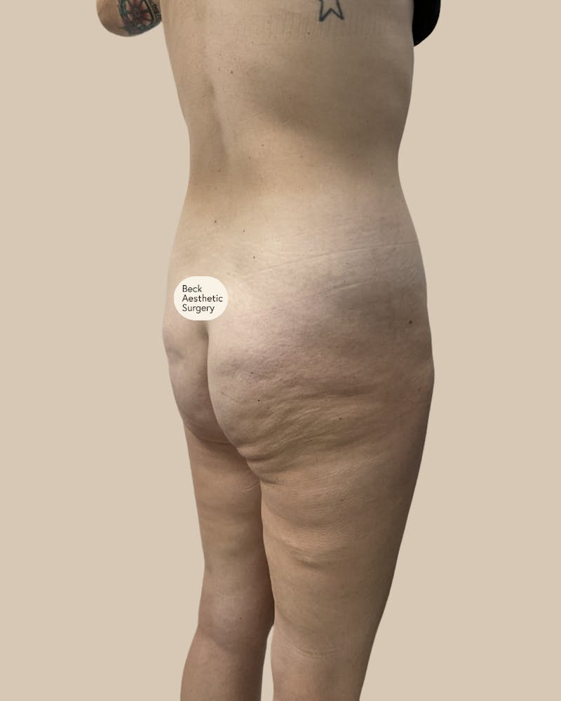 Tummy Tuck Before & After Gallery - Patient 261015 - Image 3