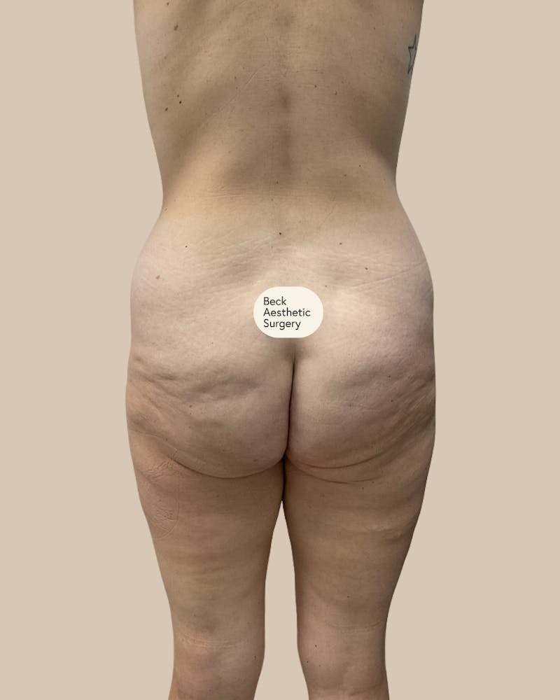Tummy Tuck Before & After Gallery - Patient 261015 - Image 5