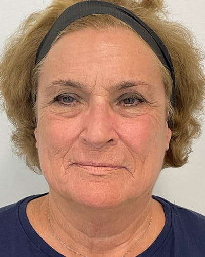 CO2 Laser Before & After Gallery - Patient 357136 - Image 2